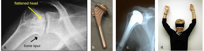 Total shoulder arthroplasty