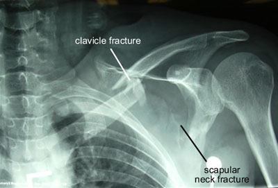 Shoulder Fractures and Dislocations
